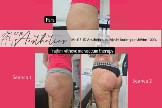 Ngritje vitheve me kupa vaccum therapy, Trajtim i vitheve me vakum, Ngritje vithesh me kupa vakumi, tonifikim trupi, Anticelulit për gjithë trupin me vakum, Masazh anticelulit per vitheve me masazh dore, Masazh anticelulit